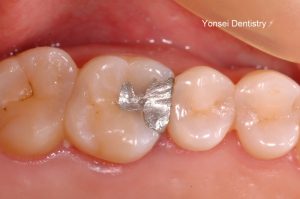아말감으로 치료한 치아에 2차 충치가 생긴 모습입니다.